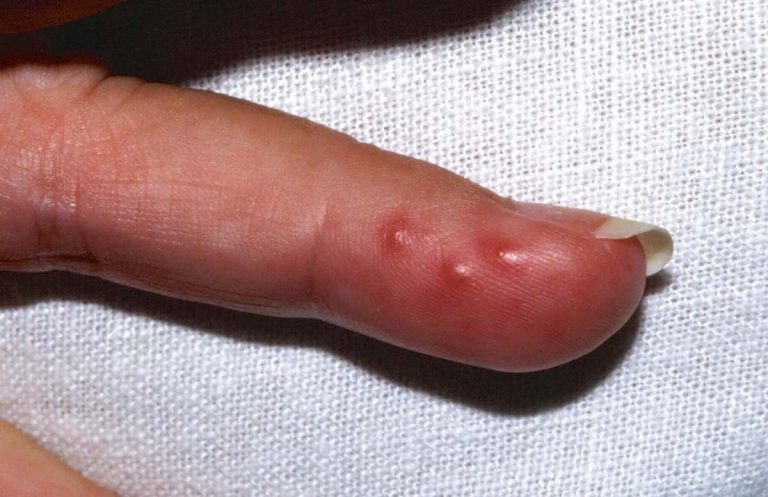 Herpes An Den Finger